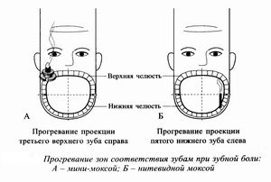 Звездочка при зубной боли